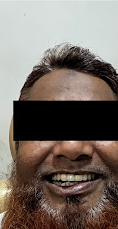 After - Smile Transformation 1